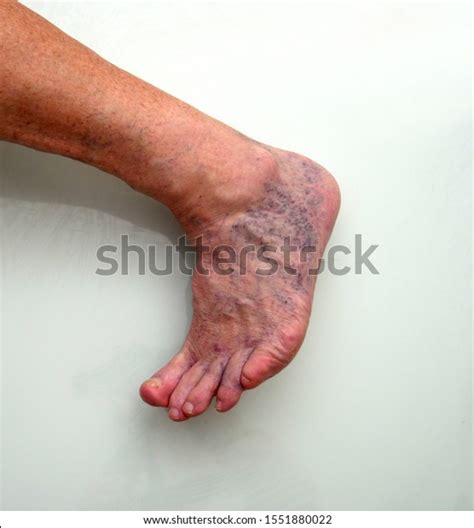 Male Foot Leg Showing Purple Mottled Stock Photo Edit Now 1551880022