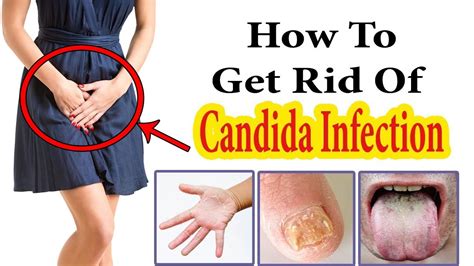 How To Get Rid Of Candida Infection At Home Home Remedies For