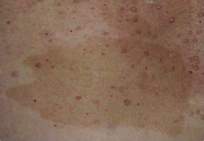 Café au lait spots, or café au lait macules, are flat, hyperpigmented birthmarks. NF1