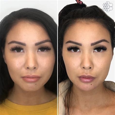 Facial Slimming Vancouver, BC | Non Surgical Jawline Treatment