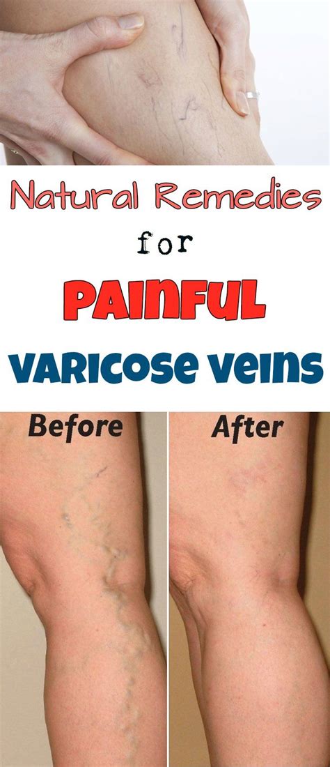 Natural Remedies For Painful Varicose Veins Beauty Total