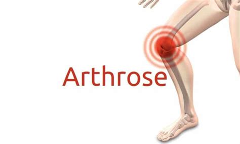 Arthrose Symptome Ursachen Und Behandlung
