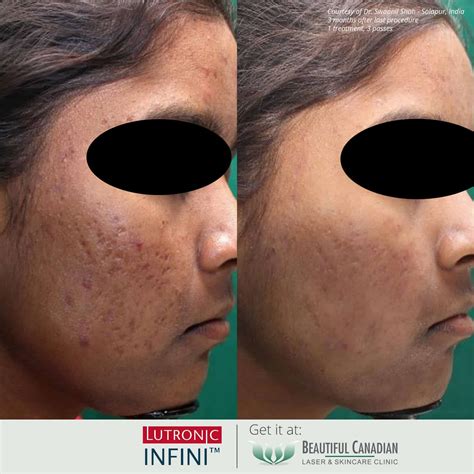 Vancouver Infini™ Rf Microneedling Surrey Collagen Induction