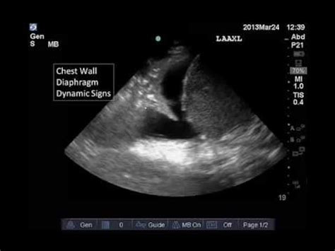 Ultrasound signs of pleural effusions. Lung and Pleural Ultrasound: Interpretation - YouTube
