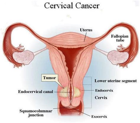 Treatment for cervical cancer depends on several factors, such as the stage of the cancer, other health higher doses of chemotherapy might be recommended to help control symptoms of very everyone deals with a cervical cancer diagnosis in his or her own way. Cervical cancer - Medical Negligence in Diagnosis and ...