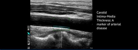 Atherosclerosis Treatment Atherosclerosis Is A Common Vascular Disease