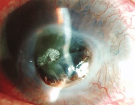 Descemetocele Perforation With A Flat And Distorted Anterior Chamber