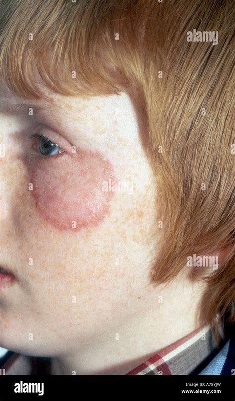 Face Ringworm Hi Res Stock Photography And Images Alamy