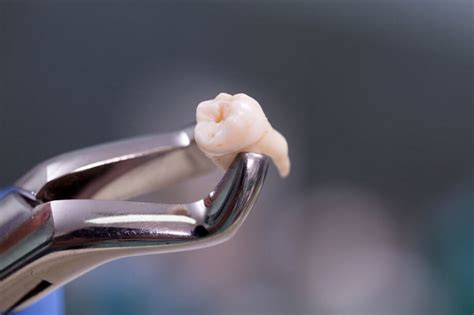 A simple extraction requires simply applying a pair of forceps to remove the tooth. What to Expect After Wisdom Tooth Extraction | Lindemann RCS