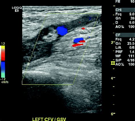 Figure From Ultrasonography Of The Lower Extremity Veins Anatomy And