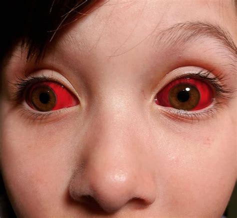 Interesting Case Of A Child Having Red Eyes Due To Subconjuctival