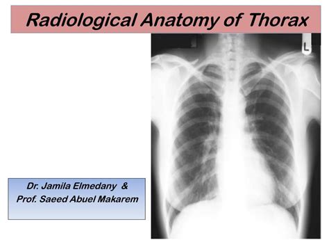 Ppt Radiological Anatomy Of Thorax Powerpoint Presentation Free