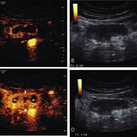 Contrast Enhanced Ultrasound Images Evaluating The Lesion At 14