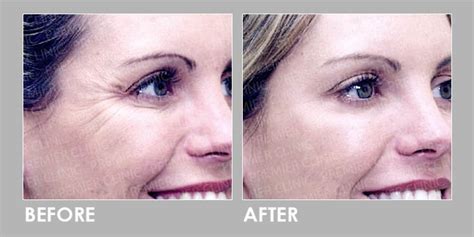 60 Off Skin Laser Eliminates Wrinkles And Improve Skin Laxity