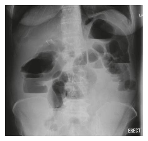 Radiographic Images Showing Malignant Bowel Obstruction A Abdominal