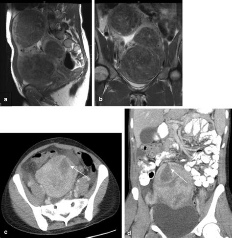 Uterine Perforation In 32 Year Old Woman Following Myomectomy A And B