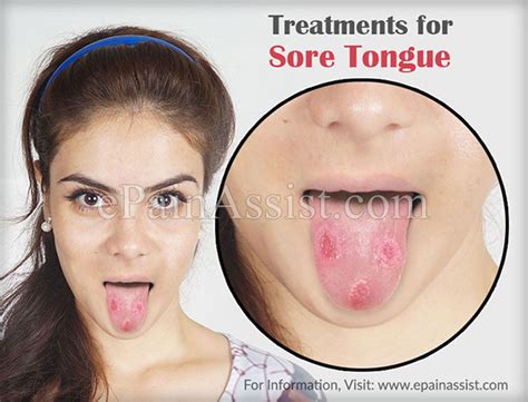 Treatments For Sore Tongue Tongue Sores Tongue Sores Causes Soreness