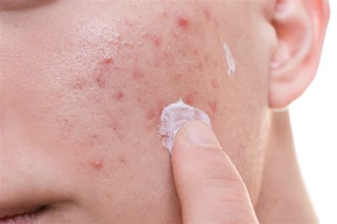 Topical Treatments For Acne