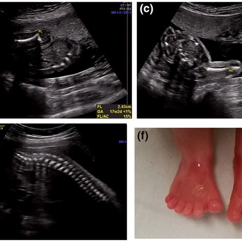 Ae Prenatal Ultrasound Of Fetus 1 At 23 Weeks Of Gestation A Narrow
