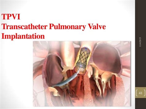 Percutaneous Pulmonary Valve Interventions