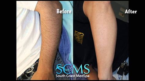 Before And After Male Laser Hair Removal Orange County Arms Youtube