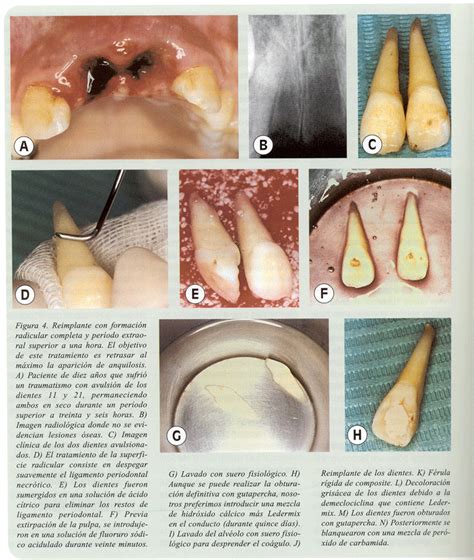 Nuevas Tendencias En El Tratamiento De La Avulsión Dental