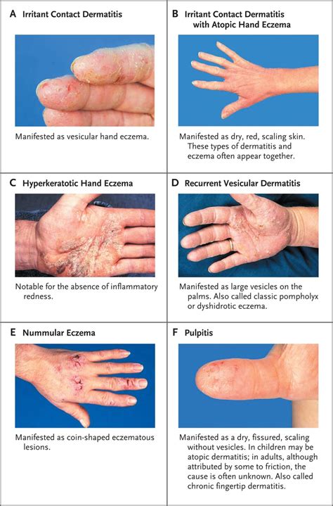 31 Contact Dermatitis Mild Eczema Types