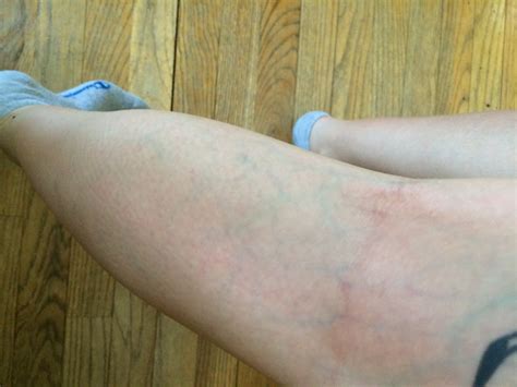 Sie kommen vor allem an den beinen vor, mitunter auch im beckenbereich. Sind das Vorboten von Krampfadern oder normale Venen ...