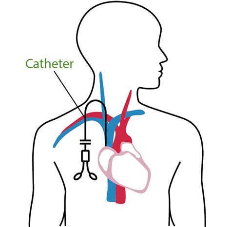 Central Venous Catheter Tip Position On Chest Radiogr Vrogue Co