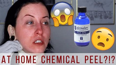 How To Do A Tca Peel At Home Tca 30 Chemical Peel Before And After