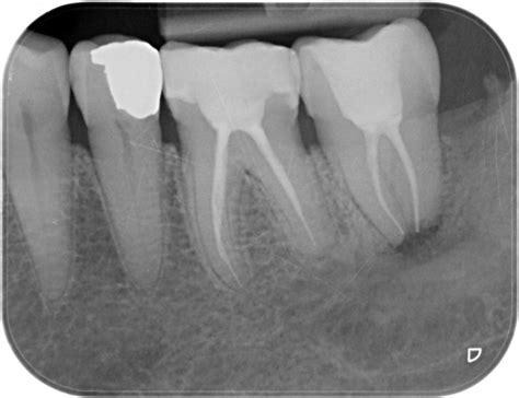 Radicular Cyst Of Jaw A Case Report