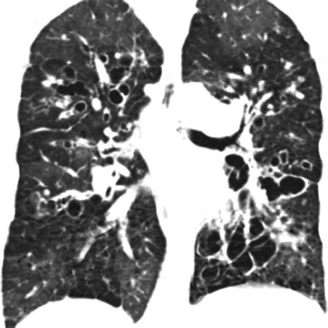 High Resolution Ct Scan Of Chest Lung Window Setting Shows Multiple