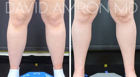 Patient 48369542 Lipedema Before And After Photos David Amron Md
