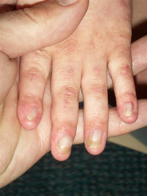 Nail Abnormalities Ectodermal Dysplasias Symptoms Nfed