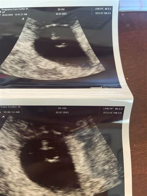 Twins Ultrasound 6 Weeks