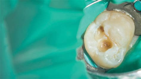 Clinical Treatment Of Deep Caries Decisions In Dentistry