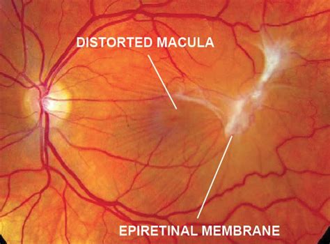 Epiretinal Membrane Macular Pucker Retina Specialists Of Michigan