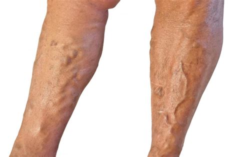What Is Superficial Vein Thrombosis With Pictures