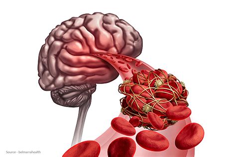 Blood Clot In Brain Causes And Symptoms HealthNews Seven