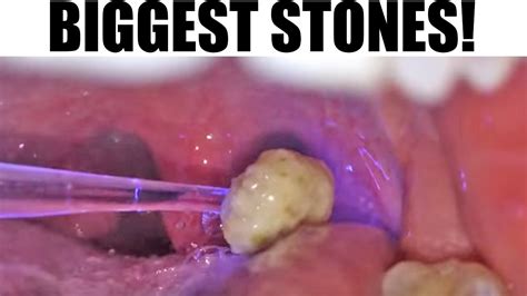 What Are Tonsil Stones What Causes Mucus Balls In Back Of Throat