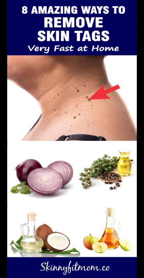 8 effective home remedies to remove skin tags at home in 2020 skin tag removal skin tags home