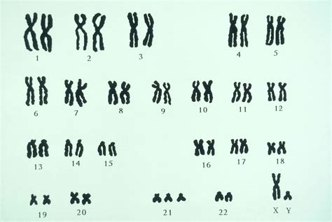 Types Of Trisomy Causes And Symptoms