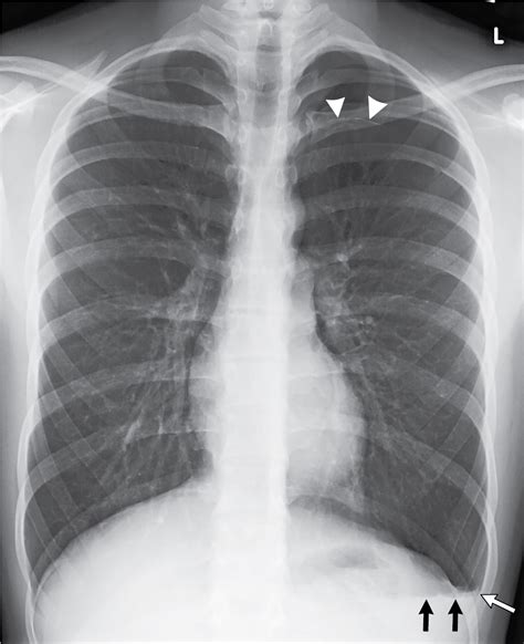 Wheres The Air Pneumothorax Radiology Key