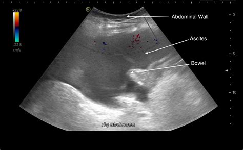 Condition Specific Radiology Ascites Stepwards