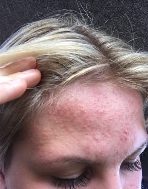 Bumps Forehead General Acne Discussion Acne Org Forum