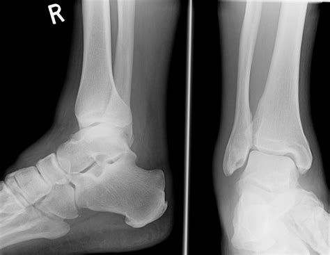 Sprained Ankle X Ray
