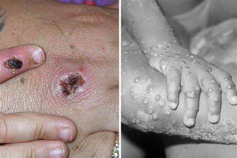 Monkeypox virus belongs to the orthopoxvirus genus in the family poxviridae. Monkeypox symptoms: What is monkeypox? How does lethal ...