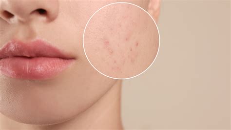 3 Ways To Get Rid Of Stubborn Acne Scars Fast Using The Best Acne Scar