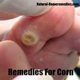Home Remedies Corn Removal Pictures