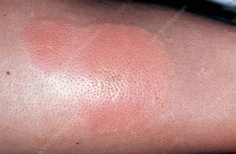 Rash On Arm Following Insect Bite Stock Image M3200162 Science